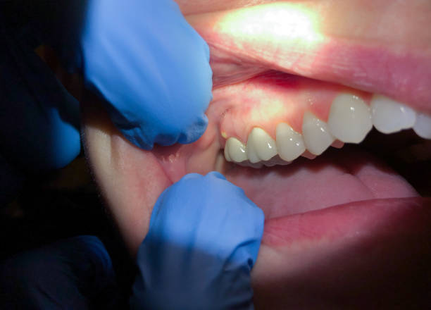 Best Emergency Root Canal Treatment in East Wenatchee, WA